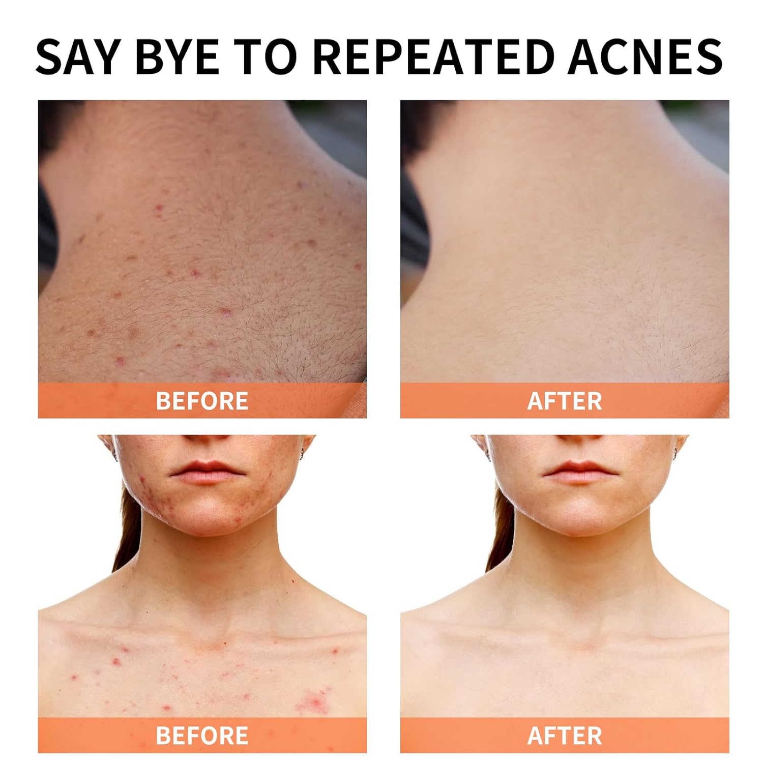 Crema Magică pentru Acnee