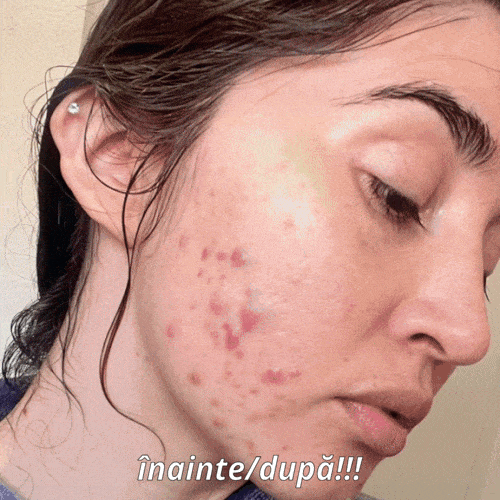 Crema Magică pentru Acnee